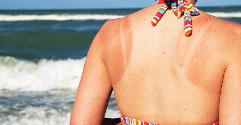 Nếu làn da của bạn đang gặp vấn đề vì bị cháy nắng