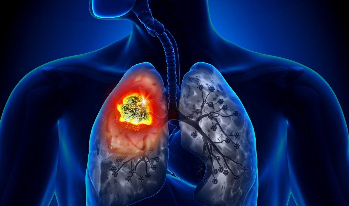 Dấu hiệu nhận biết ung thư phổi
